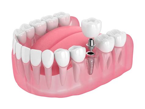 affordable low cost dental implants